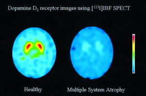 PET scans of Dopamine 2 receptors